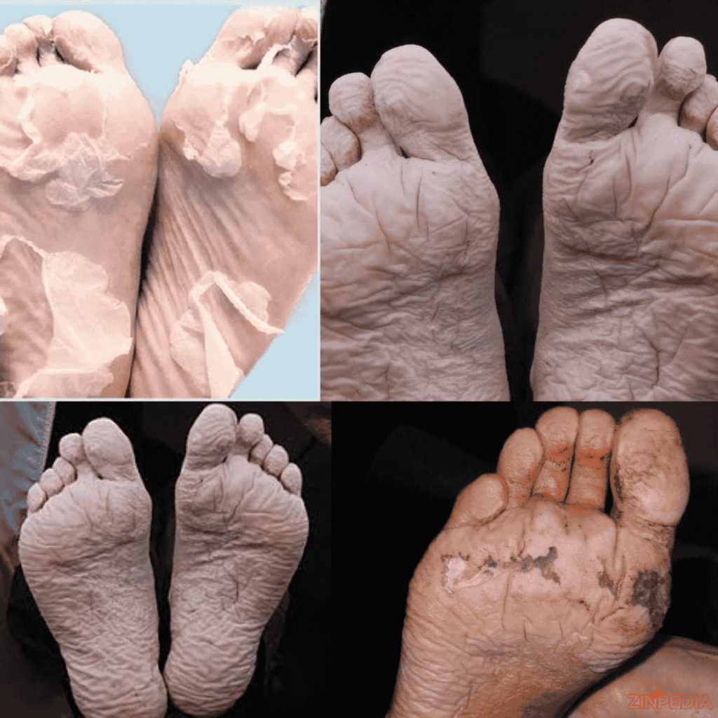 trench foot