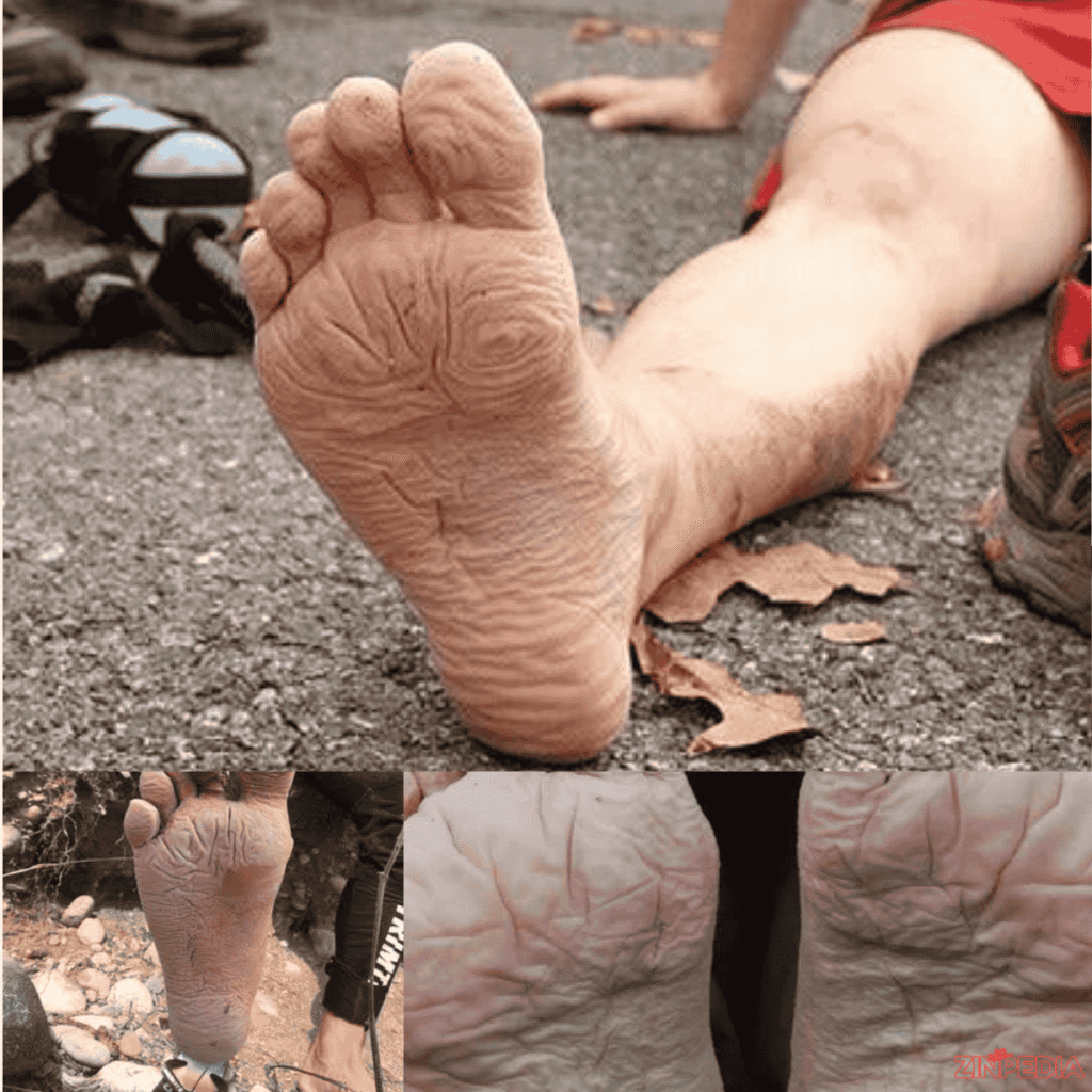 trench foot