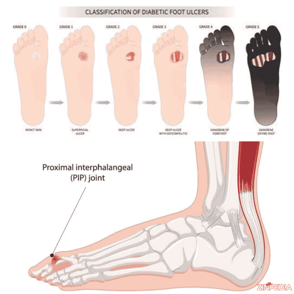 Trench Foot: A Complete Guide to Symptoms, Treatment, Recovery, and Prevention