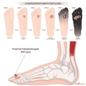 trench foot